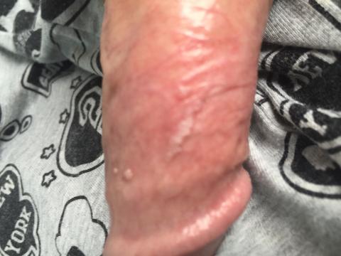 Prejav HPV?