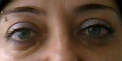 Xanthelasma